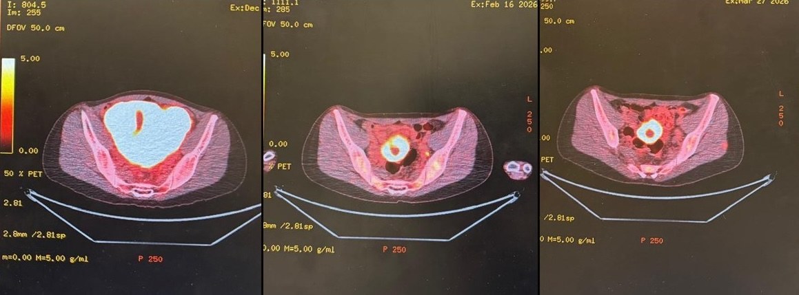 PET CT scans showing tumor progression